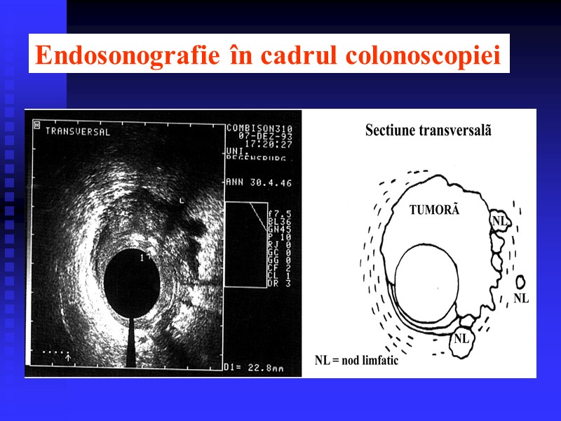 Endosonografie în cadrul colonoscopiei